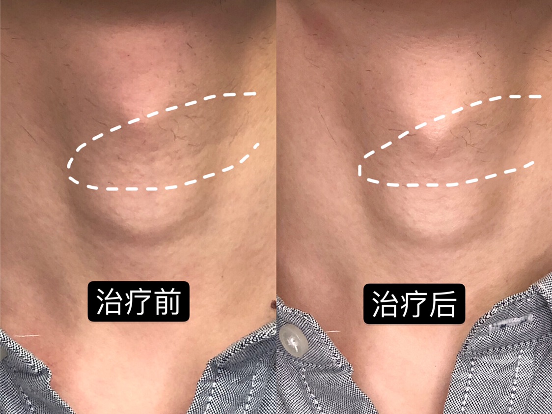 有了这个黑科技，颈纹我再也不用怕了🥰