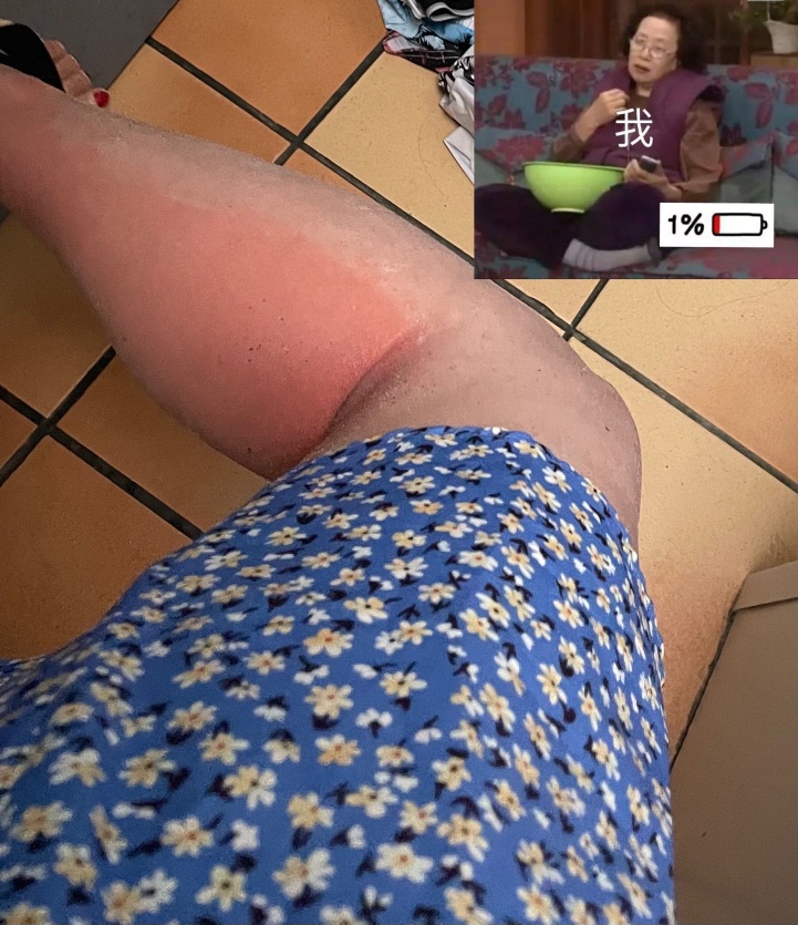 夏天当然是晒伤啊🥹