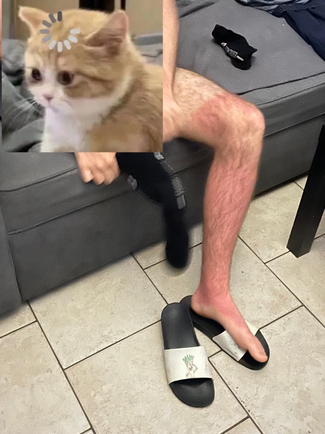 夏天当然是晒伤啊🥹