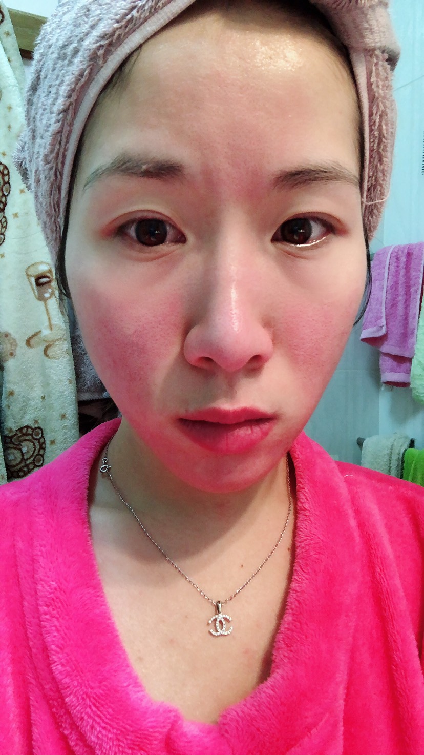 Tria美容激光仪修复痘坑痘印